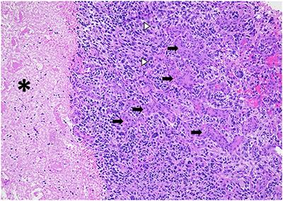 Advanced Magnetic Resonance Imaging in Pediatric Glioblastomas